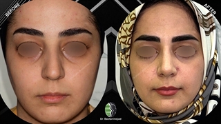 جراحی زیبایی بینی اولیه قوزدار با انحراف ظاهری