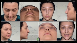 جراحی زیبایی بینی با انحراف شدید