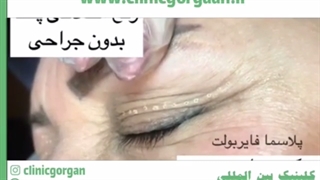 بلفاروپلاستی چیست؟