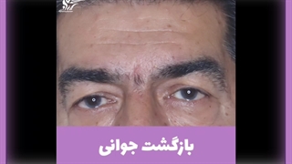 رفع پف چشم