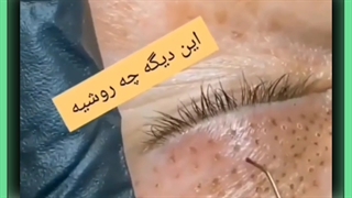 لیفت چشم