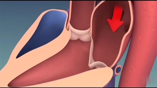 جراحی تعویض دریچه ی آئورت را جدی بگیرید!