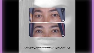 بلفاروپلاستی