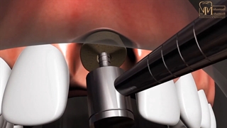 مراحل کلی کاشت ایمپلنت دندان-دکتر محمد محمدی