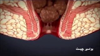بواسیر یا هموروئید چیست و چه علائمی دارد؟ partoclinic.com