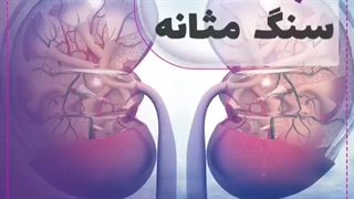 تشخیص سنگ مثانه