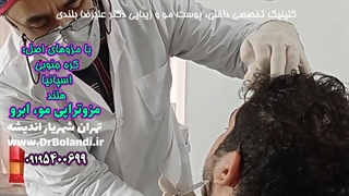 مزوتراپی مو و ابرو دکتر علیرضا بلندی برای درمان فوری ریزش مو و ... تزریق چربی