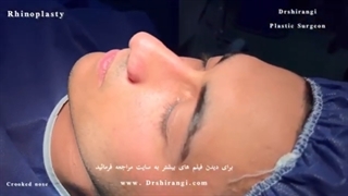 جراحی زیبایی بینی مردانه آسیایی