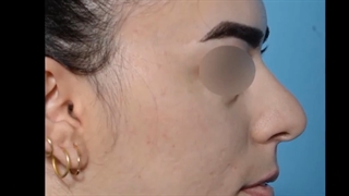 جراحی زیبایی بینی بلافاصله بعد از عمل