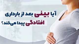 افتادگی بینی