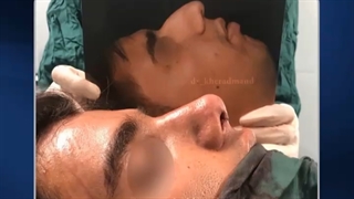 بلافاصله بعد از جراحی زیبایی بینی