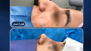 بلافاصله بعد از جراحی زیبایی بینی
