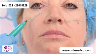 تزریق رووفیل اولترا به گونه