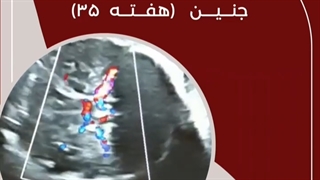 سونوگرافی کالر داپلر عروق مغز جنین (هفته ۳۵)