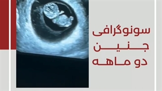 سونوگرافی جنین دو ماهه