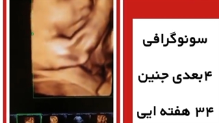 سونوگرافی جنین
