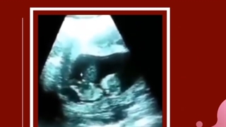 سونوگرافی جنین