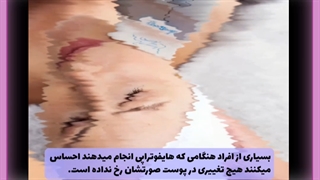 هایفوتراپی اتوپلاستی