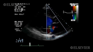 Anteroseptal ventricular septal defect