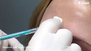 بوتاکس در شرق تهران