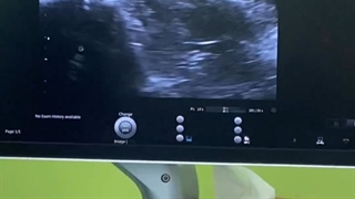 تخمک اهدایی