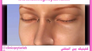 تزریق فیلر کاشت ریش